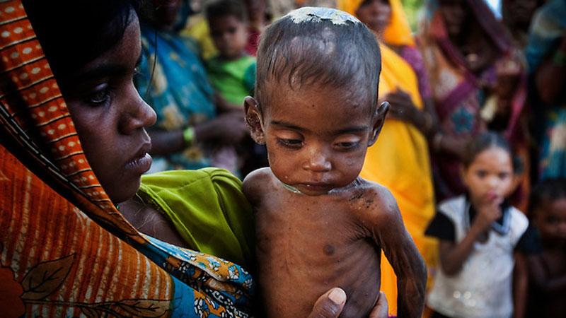 India Made no Progress in Reducing Anaemia and Childhood Wasting, Says Report