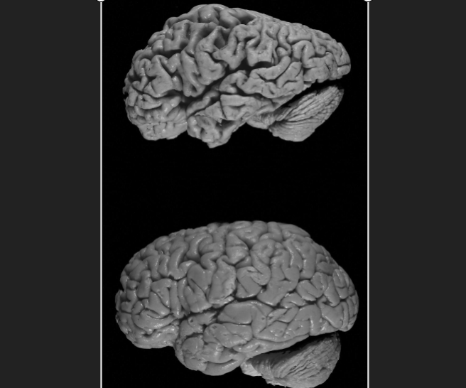 Alzheimer’s Disease: Cognitive Decline Prominent Indicator of Life Expectancy